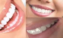 Diş Tasarımı Nedir ve Neden Önemlidir?