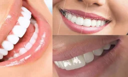 Diş Tasarımı Nedir ve Neden Önemlidir?