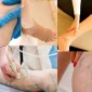 Diagnostic Process Before Varicose Vein Treatment